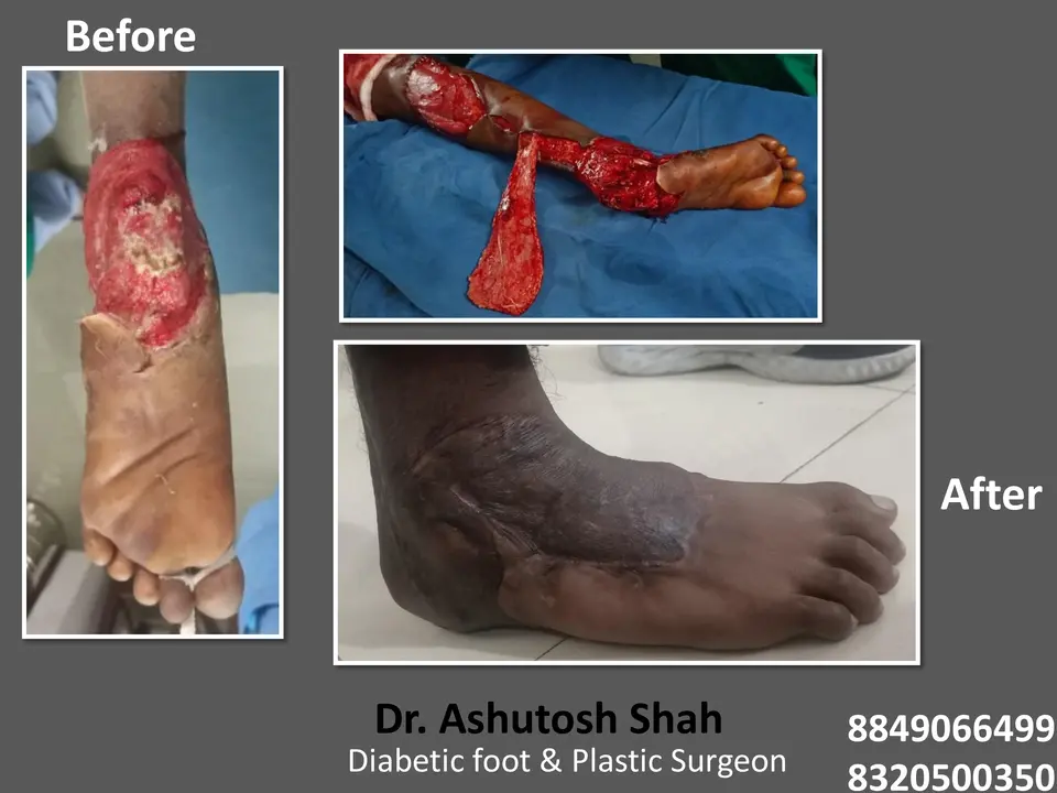 Diabetic Foot  PPT sunita.pptx-56.webp